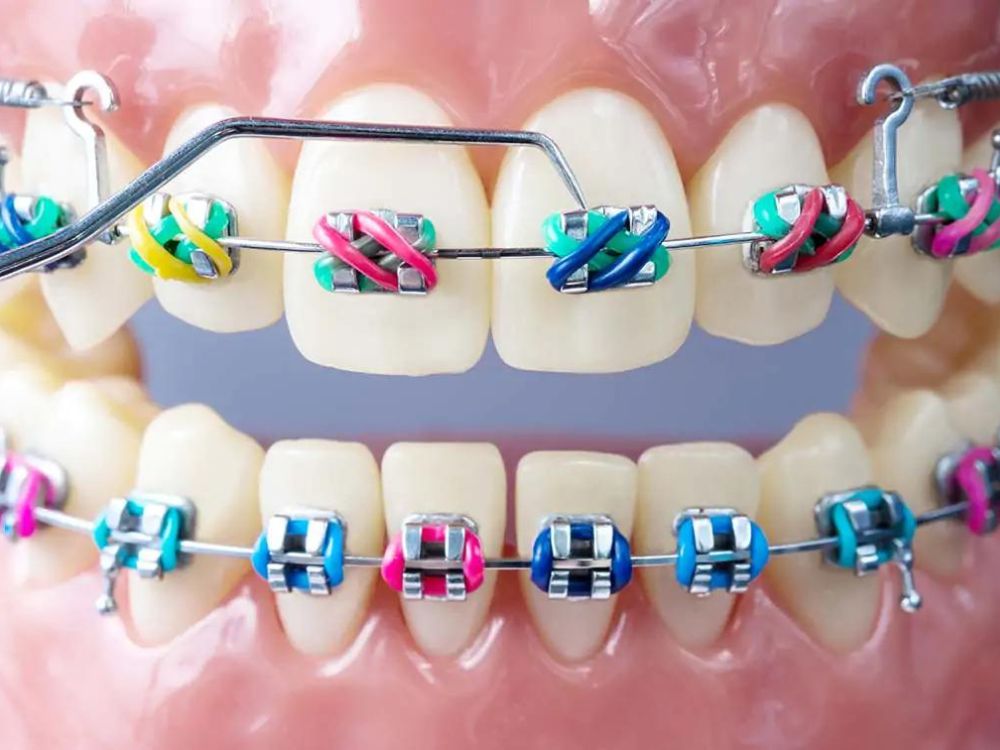 Aparelho ortodôntico fixo metálico nos dentes superiores e inferiores.