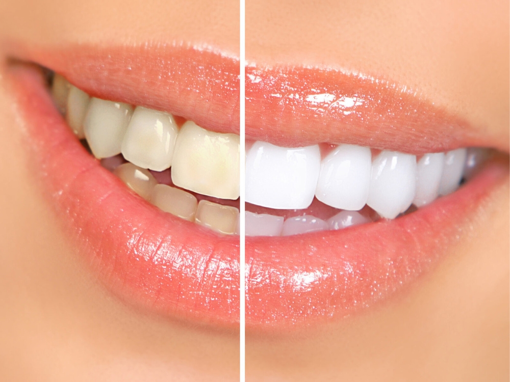 Imagem mostrando um sorriso feminino antes e depois do clareamento dental.