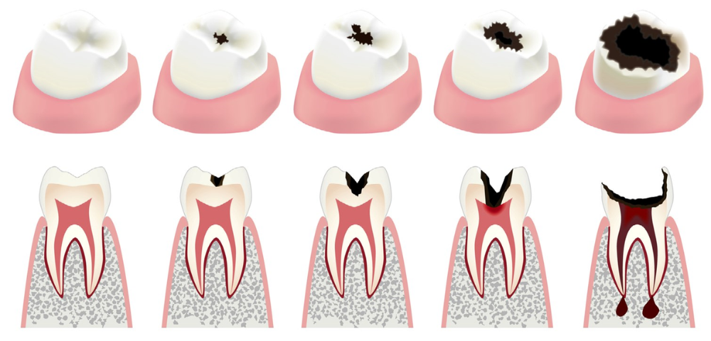 evolução do dente cariado, até a morte pulpar.