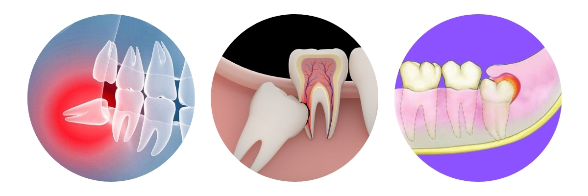 Imagem ilustrando três situações relacionadas ao dente do siso: impactação do siso, dano a dentes adjacentes e pericoronarite.