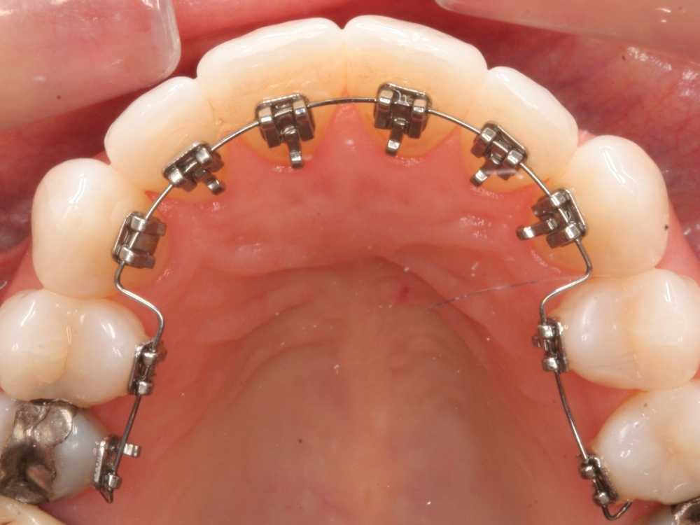 Imagem de braquetes ortodônticos colocados na superfície lingual dos dentes da arcada superior.