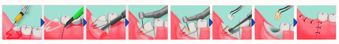 Imagem ilustrando o passo a passo completo da exodontia de sisos, desde a preparação inicial até os cuidados pós-operatórios.