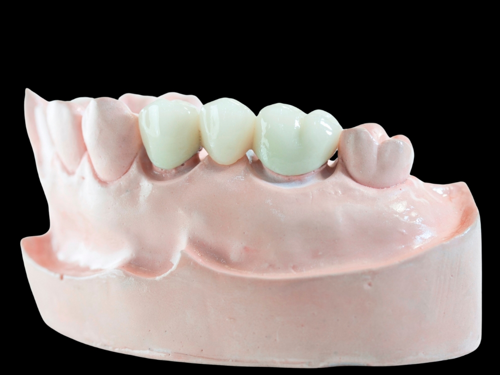 Imagem de uma prótese fixa tipo pôntico sobre um modelo de gesso, usada para substituir dentes perdidos, fixada em dentes adjacentes.