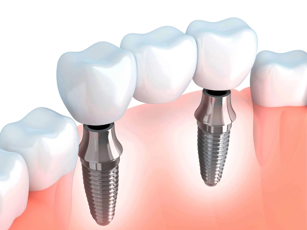 Imagem de uma prótese fixa sobre implante, tipo pôntico, mostrando um dente artificial ancorado entre implantes dentários.