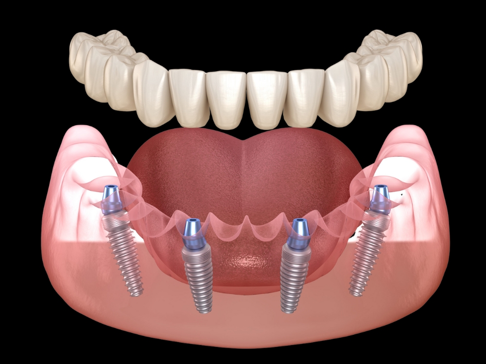 Imagem de uma mandíbula com 6 implantes dentários suportando uma prótese tipo protocolo, mostrando a fixação segura e a distribuição uniforme dos implantes.