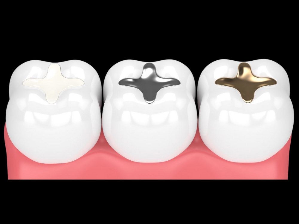 Imagem mostrando três dentes com tipos antigos de restauração dental em desuso.