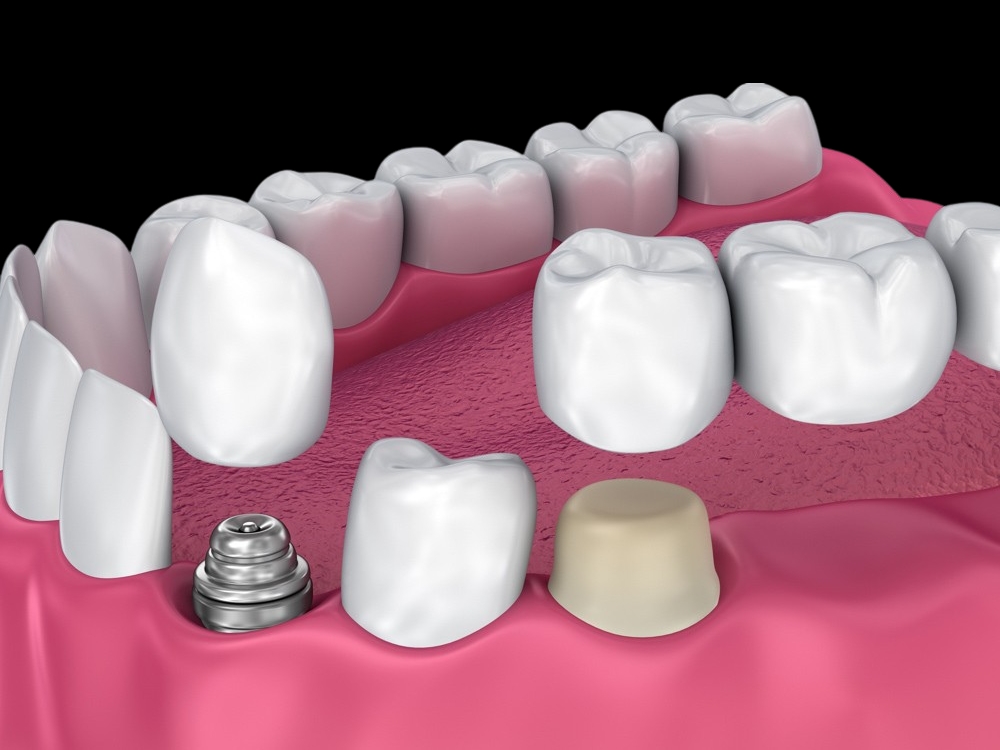 Imagem comparativa de uma coroa dentária suportada por dente natural e outra suportada por implante.