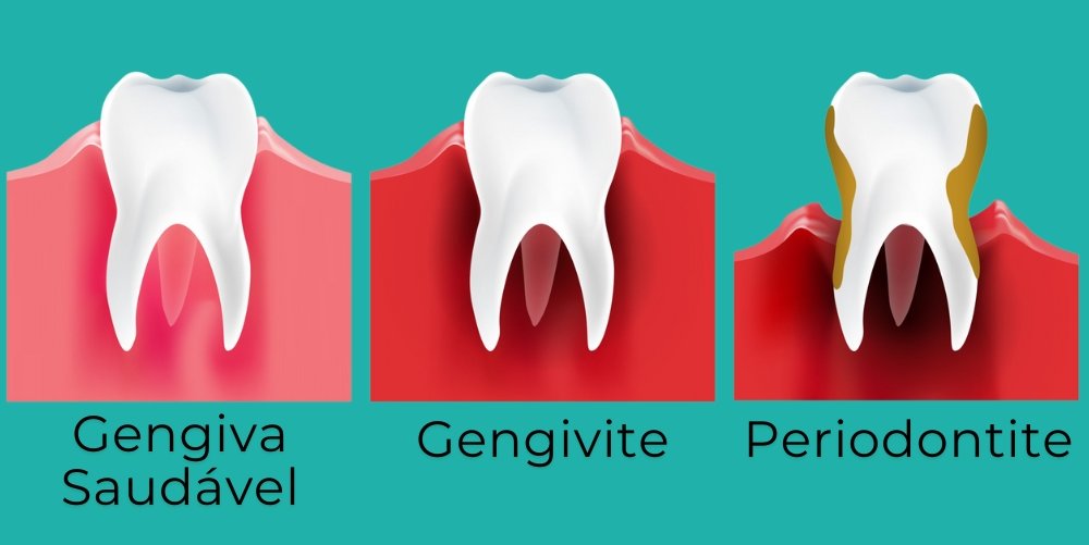 Imagem mostrando a evolução da doença periodontal: gengiva saudável, gengivite com inflamação gengival e periodontite com perda óssea.