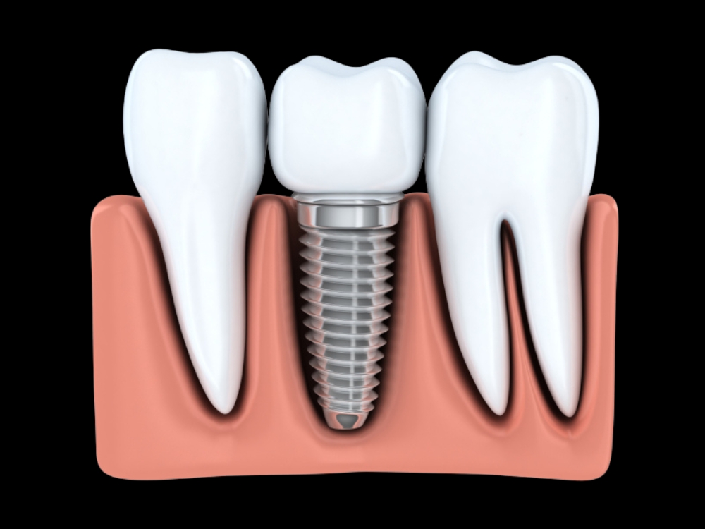 Imagem de um implante dentário unitário detalhando seus componentes, do implante à coroa.