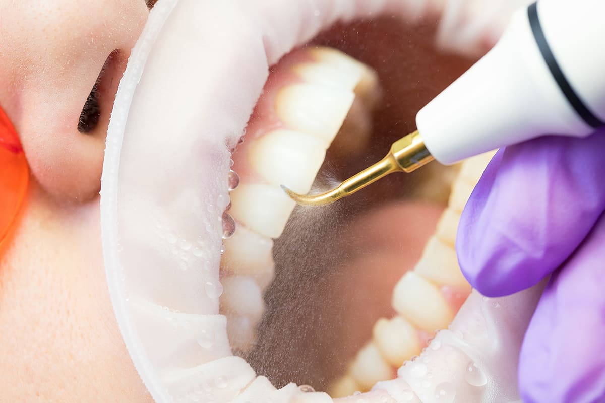 Dentista realizando limpeza periodontal com ultrassom para remover tártaro e placa bacteriana dos dentes e gengivas.