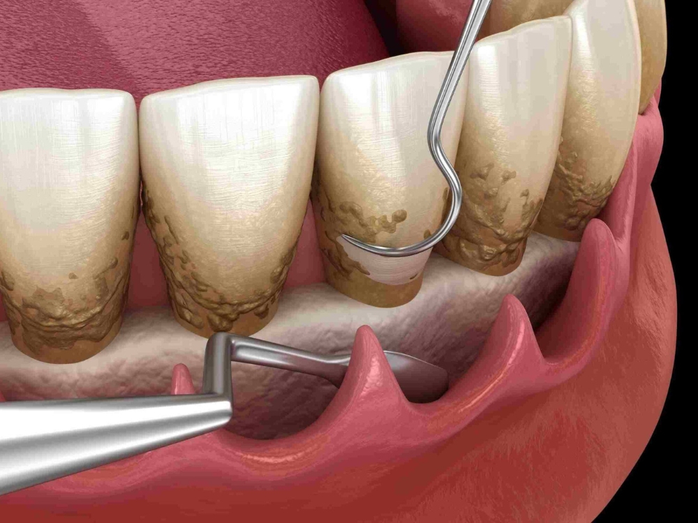 Dentista realizando raspagem subgengival com retalho para remover tártaro e bactérias das bolsas periodontais profundas.