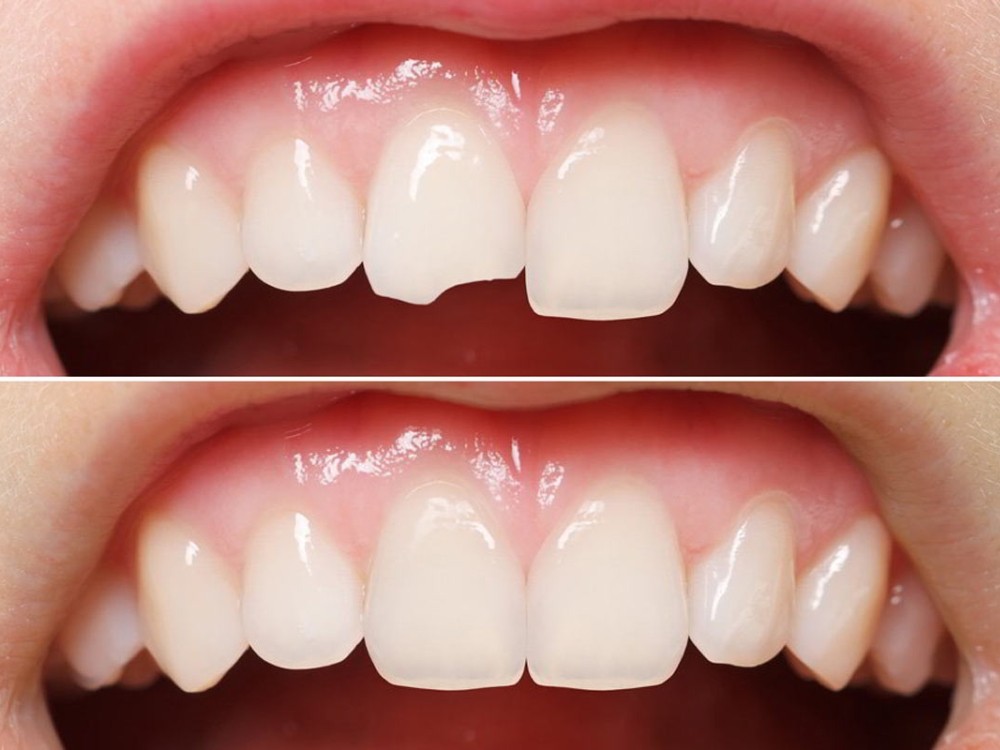 Imagem de um dente com trinca antes e depois da restauração dentária perfeita.